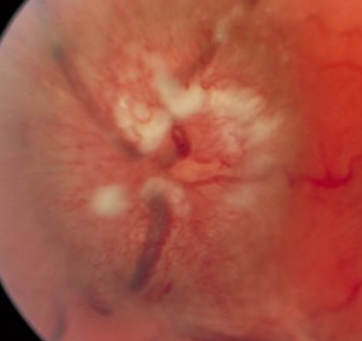 NOVEL (Neuro-Ophthalmology Virtual Ed. Library) (@novelnanos) on Twitter photo NOVEL Visual Diagnosis Challenge: We know you’re probably thinking, “That looks bad!” But how bad is it? Click on the link below to learn about papilledema staging. #nanostweets #localeyes <a href="/aiee_antonio/">Aileen Antonio, MD, FAAN</a>
collections.lib.utah.edu/search?q=subje… NOVEL Visual Diagnosis Challenge: We know you’re probably thinking, “That looks bad!” But how bad is it? Click on the link below to learn about papilledema staging. #nanostweets #localeyes <a href="/aiee_antonio/">Aileen Antonio, MD, FAAN</a>
collections.lib.utah.edu/search?q=subje…