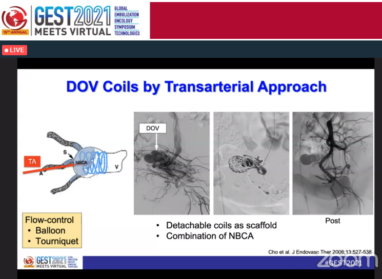 Next for Vascular Malformations Focus Day is Dr. Keigo Osuga from Osaka Medical College on Basic Tools: Embolic Agents and Chemical Ablation. 
#IRad #IRadres #TwittIR