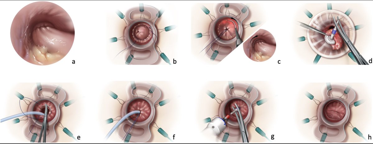 Transanal Transection and Single-Stapled Anastomosis (TTSS): A comparison of anastomotic leak rates with double-stapled technique & TaTME @AntoninoSpin @ESSOnews @escp_tweets @ASCRS_1 @colo_research @juliomayol @SWexner @3isac @debby_keller @MISIRG1 bit.ly/2XuNfoD