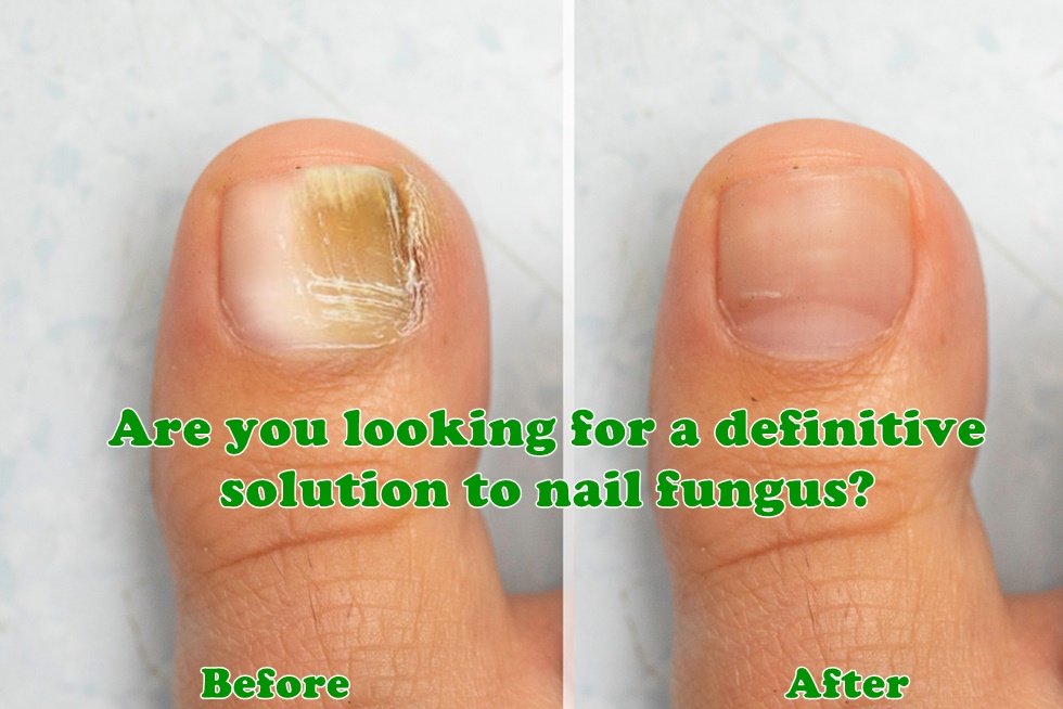 HelperKeto's tweet image. Are you looking for a definitive solution to nail fungus?
Click: bit.ly/Allkeravitapro
KeravitaPro yeast infections. 
#keravita #keravitapro #nails #yeastinfections #hairproblems #nailproblems #nailfungus #nailfungustreatment #nailinfection #nailhealth #fungalinfections