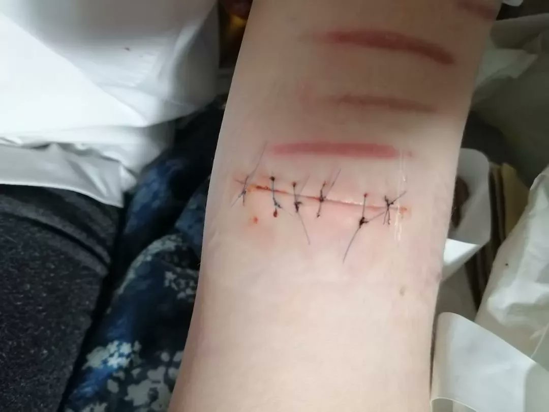 BeanFarmer5's tweet photo. OLD PICS || SHTWT getting into the depth I'm normally cutting at now, only 1 more before we are at my current shit. This was when I was doing one swipes. || #shtwt #shpics #selfharm #selfharmpics #selfharmtwt #sliceytwt #yeetwt #beantwt #heinztwt #madeofbeans #barcodetwt https://t.co/n4XkDZ26QC