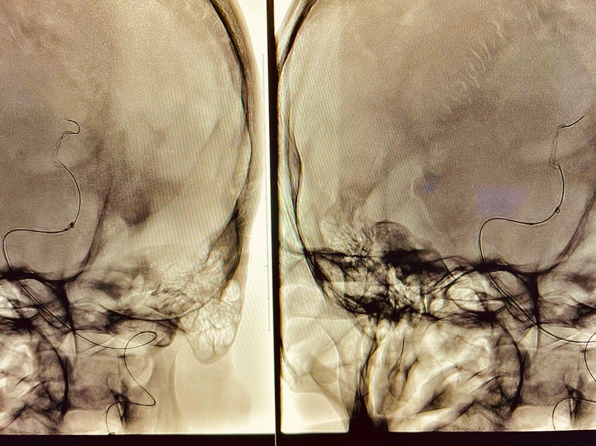 Rapid__Medical's tweet photo. 1st #Tigertriever in Chicago at the @UChicagoMed, Neuro-Endovascular surgery program. Excellent outcome Dr. Tareq Kass-Hout!
60 y/o patient suddenly developed sever stroke symptoms due to left Superior M2 and left P2 occlusion. Both were retrieved fast &amp; successfully by the Tiger https://t.co/3vaYr4N1An