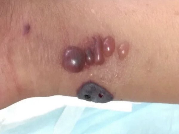 山西省 爆高傳染性「炭疽病」　
小村9人皮膚潰爛泛黑：緊急隔離
ettoday.net/news/20210815/…