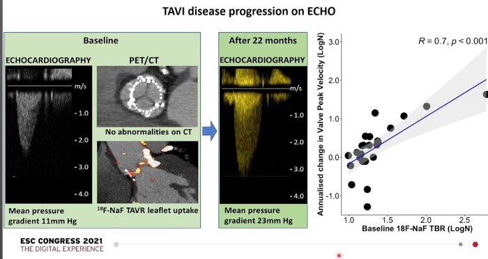 CCF_cardio's tweet photo. 🚨#ESCCongress2021🚨 
FAABULOUS II : 
✔️ Aortic disease is still progressing after TAVI 
✔️ Similar TAVI vs SAVR biosprothesis degeneration prevalence.
✔️ 18F-NaF PET is the only independent predictor of subsequent hemodynamic bioprosthetic valve degeneration. https://t.co/XtyvopKqMW