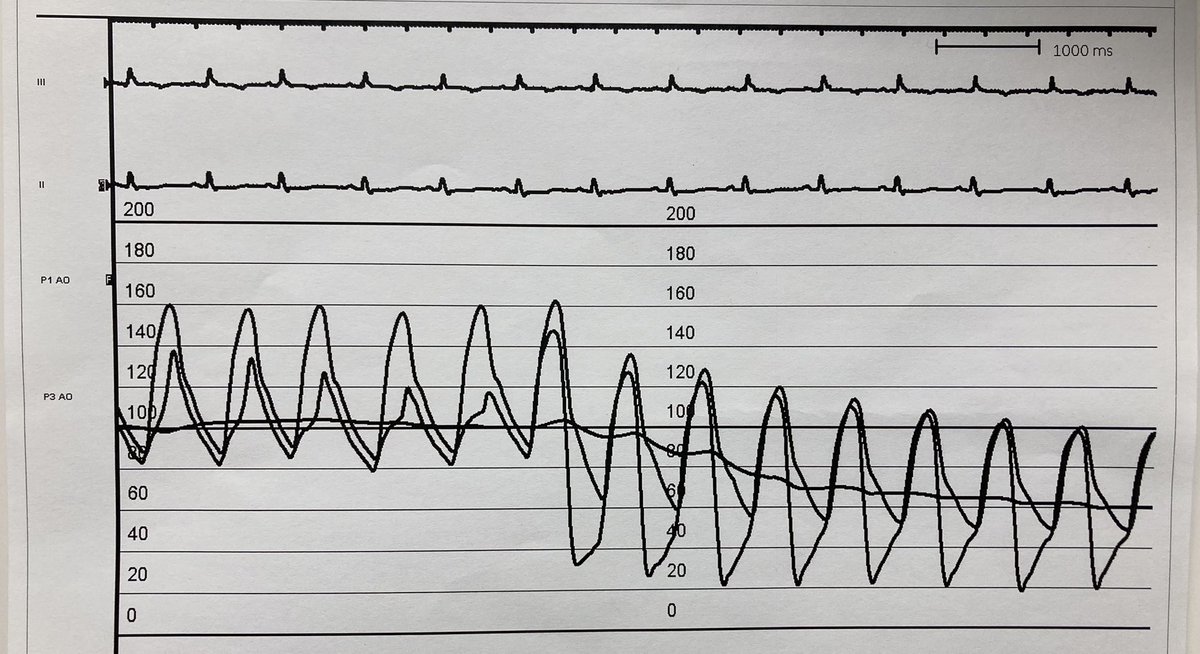Lorenzo Azzalini (@lazzalinimd) on Twitter photo What’s going on, #fellows? Sudden #hypotension during RCA #CTO #PCI while positioning a stent at the RCA ostium. (Hint: it was not a perforation) <a href="/PCRonline/">PCRonline 🫀</a> <a href="/ACCinTouch/">American College of Cardiology</a> <a href="/SCAI/">SCAI</a> <a href="/CtoEuro/">EuroCTOClub</a> <a href="/ABeneduceMD/">Alessandro Beneduce</a> <a href="/FrnMoroniMD/">Francesco Moroni, MD</a> <a href="/ikutkutMD/">Issa Kutkut</a> <a href="/Babarkahn1/">Babarkahn</a> <a href="/VCUHealthHeart/">VCU Health Pauley Heart Center</a> <a href="/AbbateAntonio/">AntonioAbbate</a> <a href="/abouzaki_md/">Nayef Abouzaki, MD</a> What’s going on, #fellows? Sudden #hypotension during RCA #CTO #PCI while positioning a stent at the RCA ostium. (Hint: it was not a perforation) <a href="/PCRonline/">PCRonline 🫀</a> <a href="/ACCinTouch/">American College of Cardiology</a> <a href="/SCAI/">SCAI</a> <a href="/CtoEuro/">EuroCTOClub</a> <a href="/ABeneduceMD/">Alessandro Beneduce</a> <a href="/FrnMoroniMD/">Francesco Moroni, MD</a> <a href="/ikutkutMD/">Issa Kutkut</a> <a href="/Babarkahn1/">Babarkahn</a> <a href="/VCUHealthHeart/">VCU Health Pauley Heart Center</a> <a href="/AbbateAntonio/">AntonioAbbate</a> <a href="/abouzaki_md/">Nayef Abouzaki, MD</a>