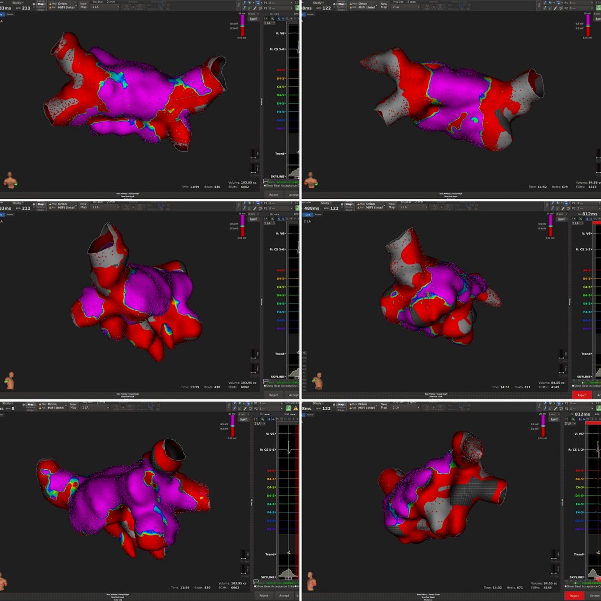 can_yontar's tweet photo. Re-do of a prior PVI case, before/after...classically at ridge and RSPV-roof reconnections...a few RF applications have sealed PVs once again...@BSCCardiology #directsense #mifi https://t.co/c9Z4Mt8W5j
