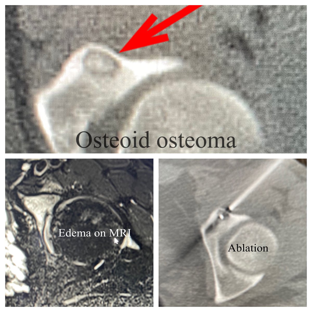 bhat_ambarish's tweet photo. Classic hip OO expertly treated by my partner @RyanMDavis2 👏🏽👏🏽. This minimally invasive procedure relieved the patient’s symptoms in a matter of days! #IRad #RFA #osteocool @Medtronic #samedaydischarge @CAIRrfs @radRounds @SIRspecialists @SIR_ECS https://t.co/wdJQ5OVp9c