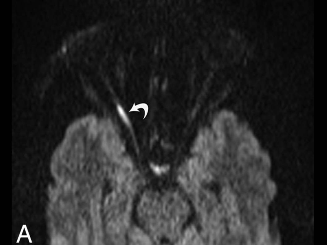 Hyperintense Optic Nerve due to Diffusion Restriction: Diffusion-Weighted Imaging in Traumatic #opticneuropathy ajnr.org/content/36/8/1…