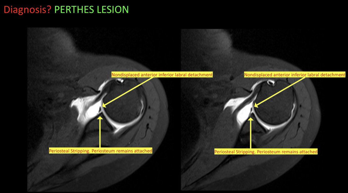 amfischer89's tweet photo. Case 31- PERTHES LESION! See attached teaching points on Bankart Variants. Enjoy! @ufjaxrads #FOAMed #FOAMrad #radiology #MSKRad #radres #futureradres #MedEd #medtwitter #orthotwitter @SSRbone @ssr_rwg @KurraChandana https://t.co/7c5NPUDAlA