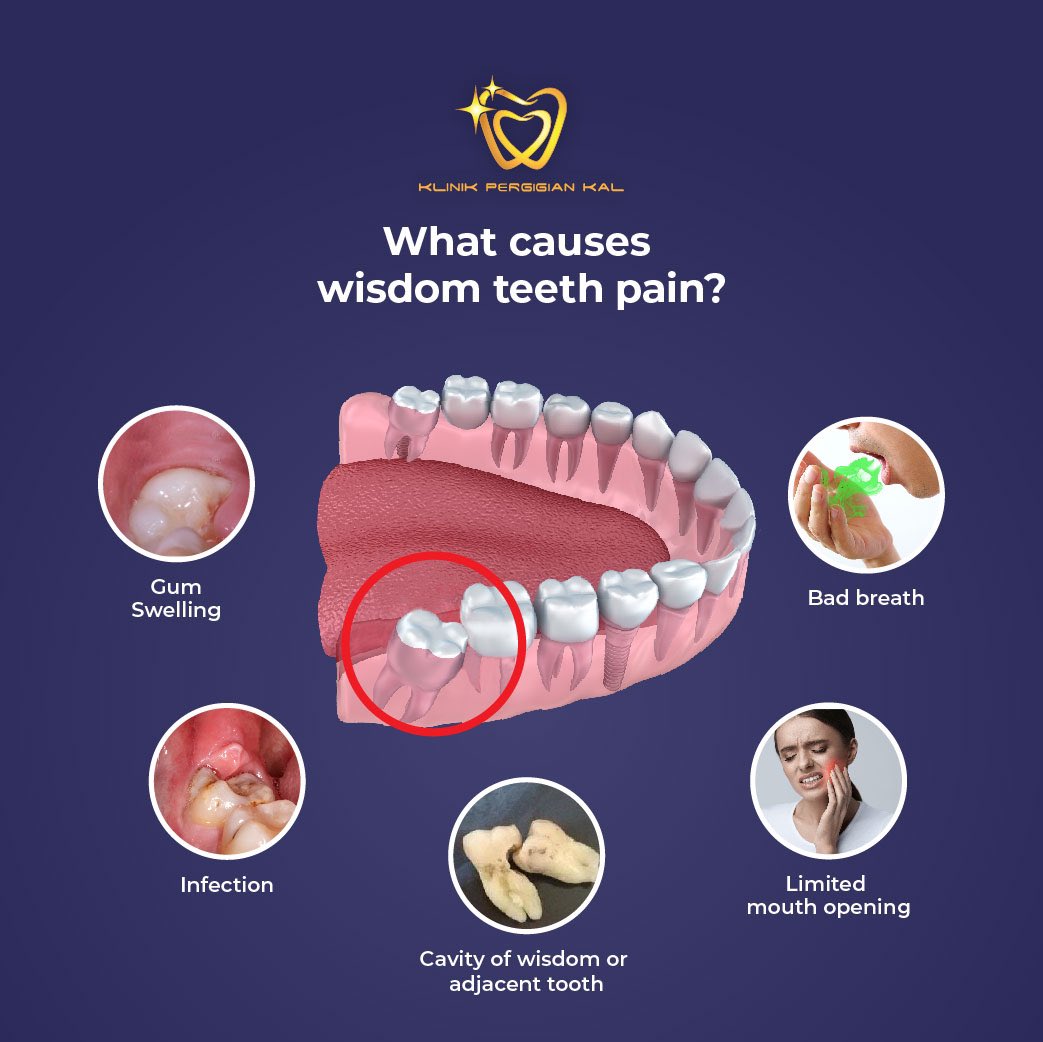 Kaldentalclinic On Twitter Bila Gigi Bongsu Ni Kena Cabut Tak Semua Gigi Bongsu Ni Wajib Kena Cabut Tapi Bila Ada Signs And Symptoms2 Ni Most Likely Dentist Akan Advise Untuk Cabut Tapi
