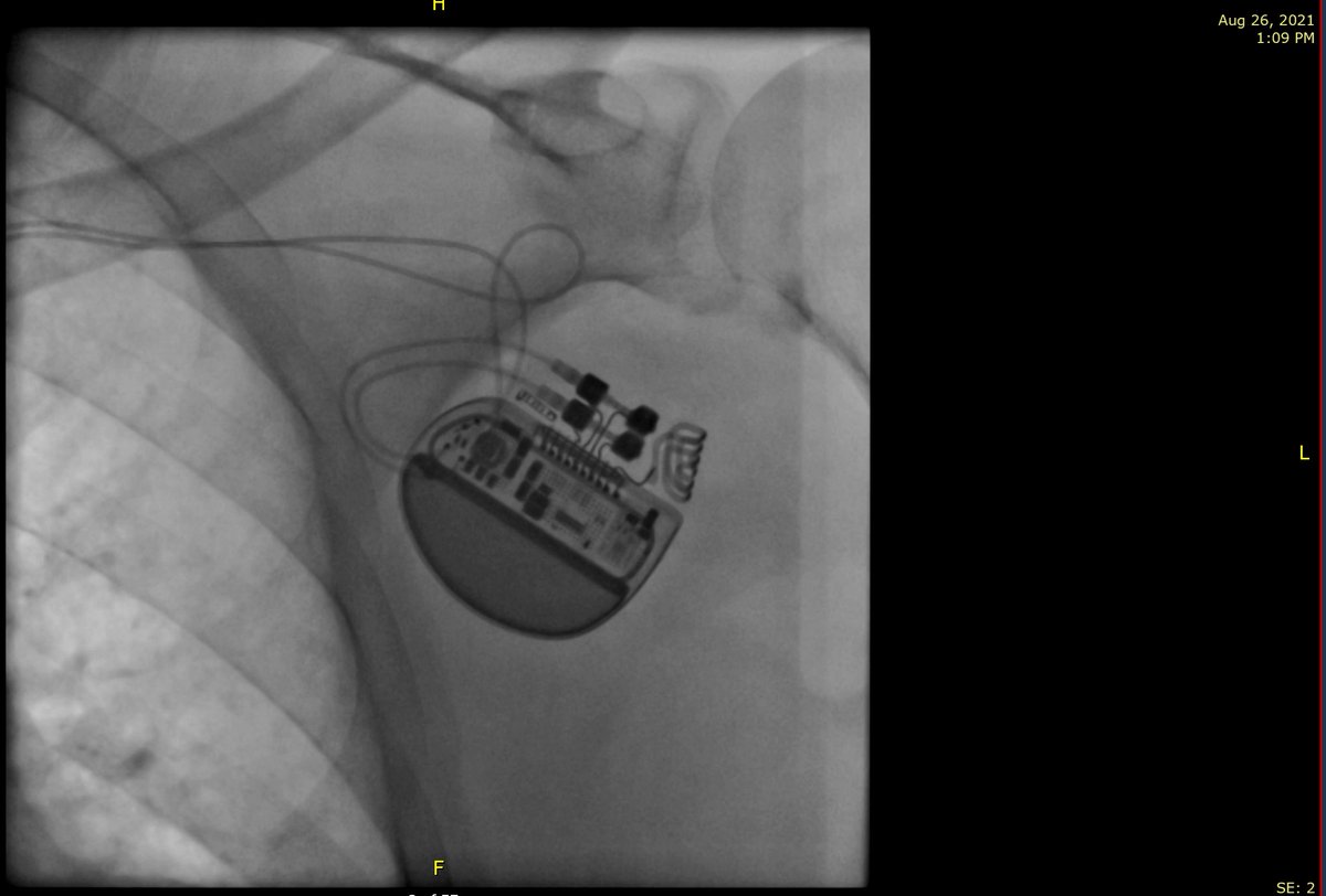 The situation is bad! This is one of the last pacemakers left in the country that I implanted on Thursday. The lives of many patients will be at risk with lack of availability of pacemakers.  #لبنان ليس بخير