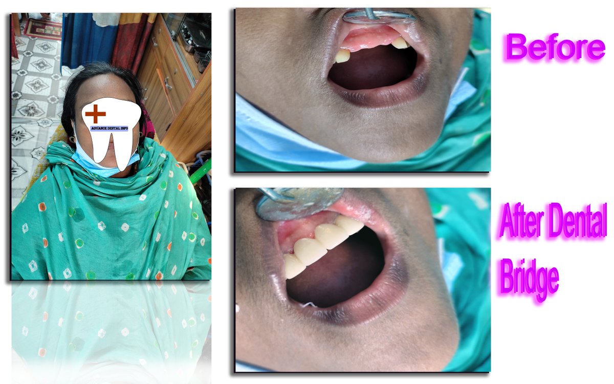 After Dental Bridge more information click my youtube channel in bangla
youtube.com/playlist?list=…

#भगवदगीता_के_गूढ़_रहस्य 
#250MforVaathiSupremacy
 #dentalcap #RCT #dentalbridge
#MCIARS #Arsenal  #ENGvsIND #250MforVaathiSupremacy