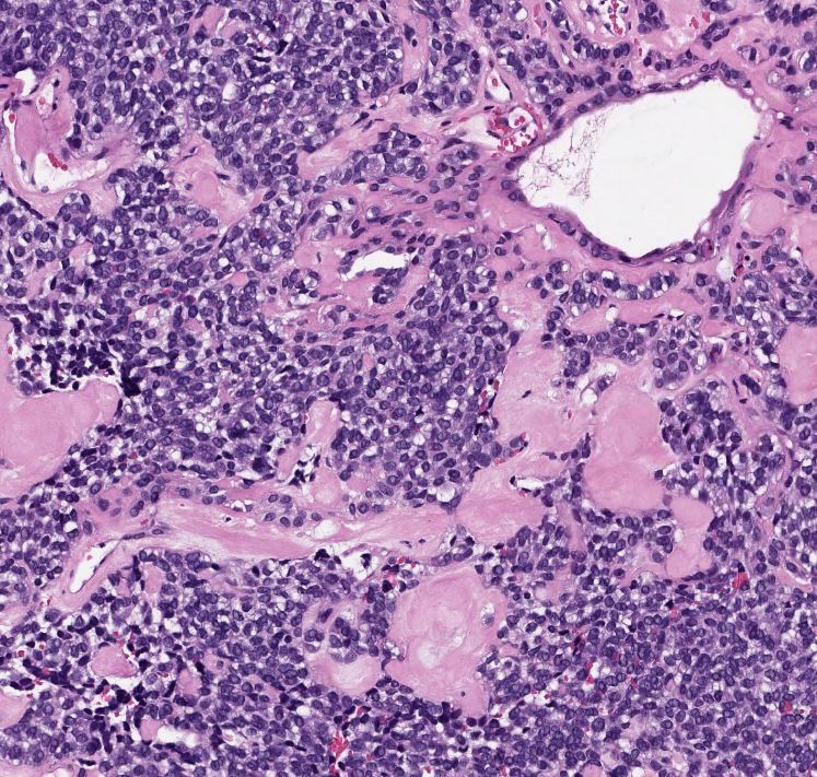 megothelioma's tweet photo. Pleomorphic adenomas have a wide variety of morphologies - this one showed scattered ductal components and hyalinized stroma. Not all PAs have myxoid stroma! #PathTwitter #MSGPath https://t.co/ACQ5dSgNPf