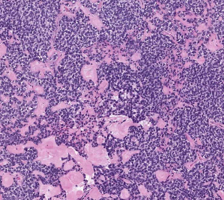 megothelioma's tweet photo. Pleomorphic adenomas have a wide variety of morphologies - this one showed scattered ductal components and hyalinized stroma. Not all PAs have myxoid stroma! #PathTwitter #MSGPath https://t.co/ACQ5dSgNPf