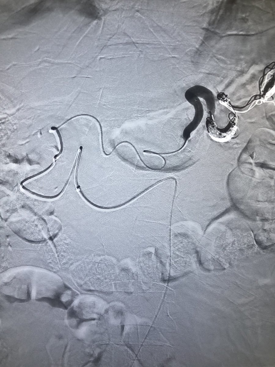 All that played in my head throughout this splenic embo via PDA 2/2 chronically occluded celiac artery was “Love Rollercoaster” by the Ohio Players…which are the only players from that state I respect because #GoBlue and college football is back!