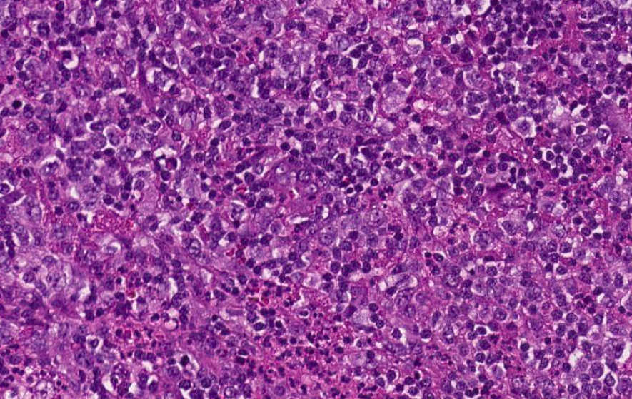 SibaElHussein's tweet photo. #LessonsfromtheFridayUnknowns CHL with syncitial features and diffuse strong CD30 expression,mimicking ALCL, shown to us by @ljmedeirosMD during #LJMFridayUnknowns➡️ https://t.co/iCDhg9OKlT 

@KirillLyapichev @RMirandaMD @Dowhankim @Xiaoqiong_Wang 

#hemepath #pathtwitter #lymsm https://t.co/9DUulMRzwz