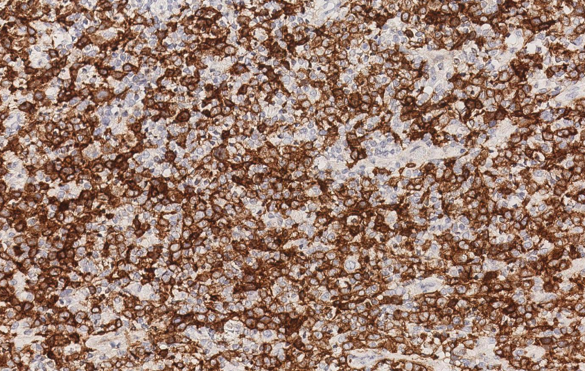 SibaElHussein's tweet photo. #LessonsfromtheFridayUnknowns CHL with syncitial features and diffuse strong CD30 expression,mimicking ALCL, shown to us by @ljmedeirosMD during #LJMFridayUnknowns➡️ https://t.co/iCDhg9OKlT 

@KirillLyapichev @RMirandaMD @Dowhankim @Xiaoqiong_Wang 

#hemepath #pathtwitter #lymsm https://t.co/9DUulMRzwz