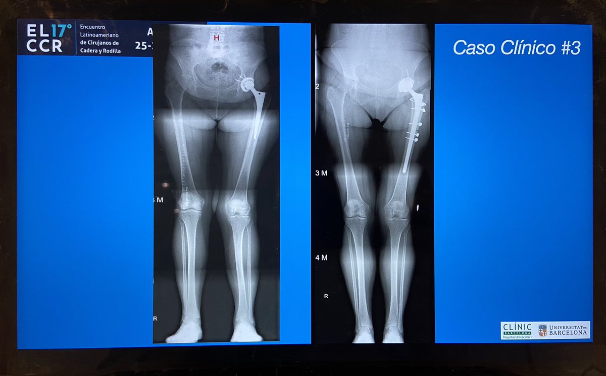 JenaroFV_MD's tweet photo. Hoy he participado en el 17° Encuentro Latinoamericano de Cirujanos de Cadera y Rodilla - #ELCCR - para hablar de qué hacer en dismetría sintomática en pacientes operados de prótesis de cadera. ¡Muy agradecido por la invitación y enhorabuena por el Congreso! @SCCOTCOLOMBIA https://t.co/6DG8n8Zj5P