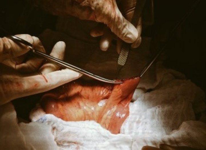 Some technical hints to avoid bowel anastomosis leack. #SoMe4IQLatAm #SoMe4Surgery #medtwitter 1/7 Bowel should should have adequate arterial blood supply and venous drainage in order to heal.