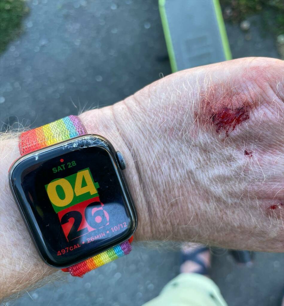 Souvenir from LINK Scooter Share. Damaged iWatch, too, as well as skin shredded off elbow and toenail. Injuries sustained while starting on my second ride in a month. Harbor Avenue near Marination Ma Kai — Saturday, August 28, 2021. #link #linkscooters #scootershare #injurie…