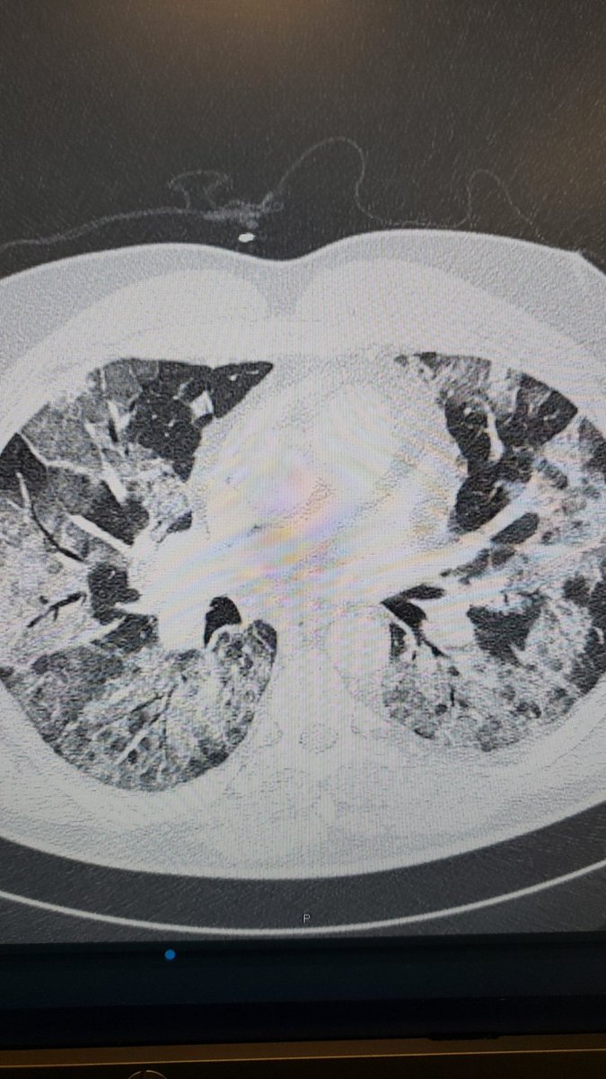 I've resorted to showing healthy people their COVID-mutilated lungs on CT in an effort to get them to tell their friends and family to be vaccinated.

Young. (Previously) healthy.