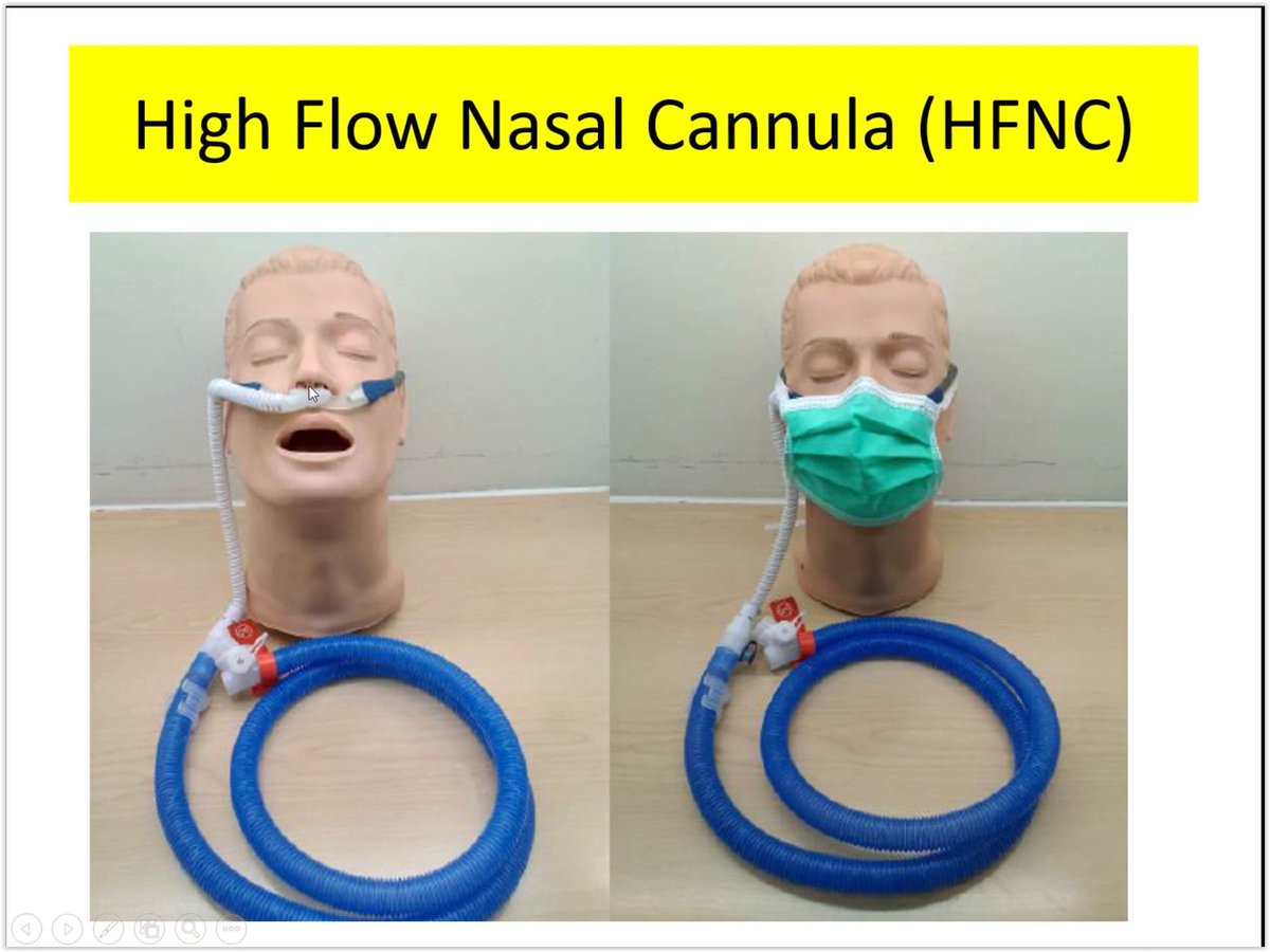 cheahwc's tweet image. 🩺Surgical mask on top of high-flow nasal cannula improves oxygenation in critically ill COVID-19 patients with hypoxemic respiratory failure.
🎯⬆️⬆️Oxygenation
🎯⬇️⬇️Aerosol 
#CaduceusEM 
🌐annalsofintensivecare.springeropen.com/.../s13613...