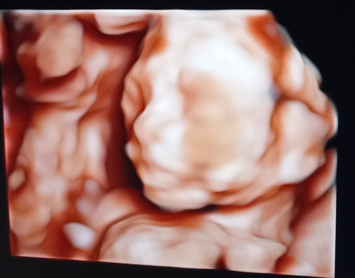 riskanong's tweet photo. Hallo baby number 2, setelah sempet abortus maret lalu, alhamdulillah langsung dikasih kepercayaan lagi 1 bulan kemudian .. sehat² yaa sayang, sama²berjuang kita yaa di tahun pandemic ini .. 🥰😇 #20w5dpregnant https://t.co/ZbwZhl4NO2