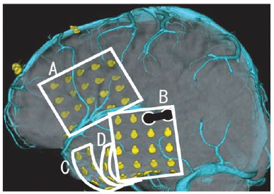 JClinNeurophys's tweet photo. Arihara et al. investigate in this study the utility of steady-state #CCEPs (SSCCEPs). #SSCCEPs were recorded in areas consistent with conventional CCEPs. SSCCEPs could be a useful alternation to conventional CCEPs. #steadystate #brainnetwork @ACNS_org https://t.co/3ywv2Scgls https://t.co/WEagTgvY9s
