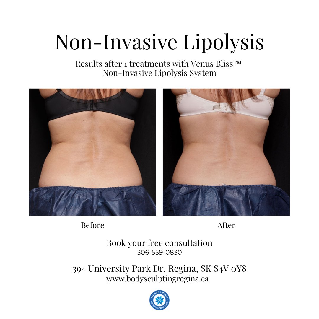 BodySculptYQR's tweet photo. Research has shown a significant reduction in adipose layer thickness of the flanks when measured by ultrasound 12 weeks after treatment.

Courtesy of Laser &amp; Skin Surgery Center of Northern California, Suzanne Kilmer, MD

👉 15% OFF until August 31st
https://t.co/w6sZ2TpgAX https://t.co/y858tc9zuV