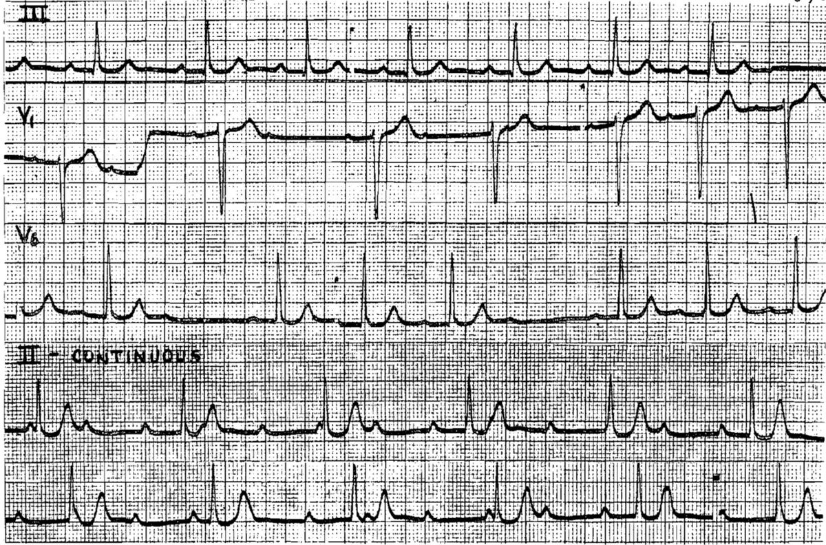 55 Years old lady with recurrent Dizzy Spells.
❓ Degree of AV Block ❓

⬇️ Interpretation and Answer : 

👉 manualofmedicine.com/ecgs/ecg-case-…

#meded #medtwitter #foamed #ecg #CardioTwitter