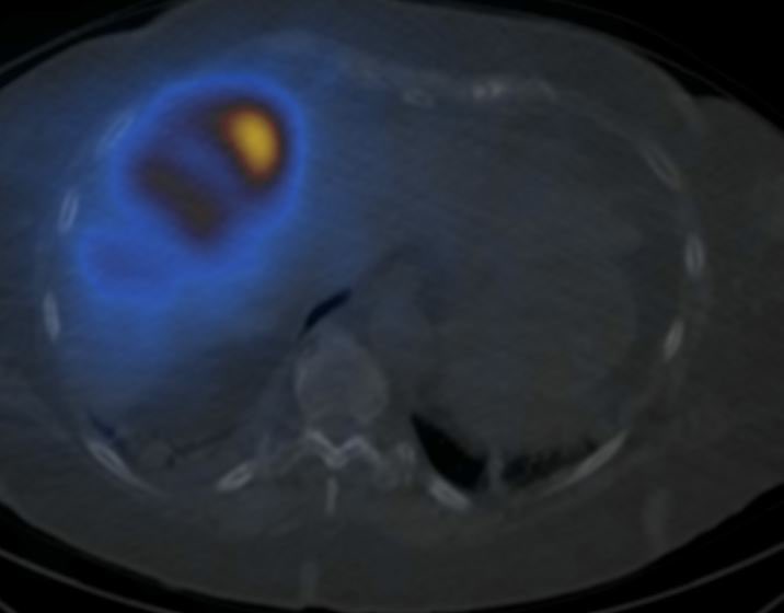 The British Society of Interventional Radiology tweet media