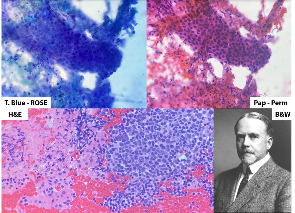 drruizcor's tweet photo. FNA showed abundant cellular debris and few clusters of epithelioid & lymphoid cells. https://t.co/i3jxmifX8R