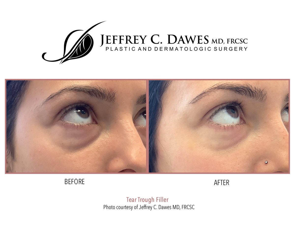 JeffreyCDawesMD's tweet image. Tear Trough Filler (under eyes) can truly refresh your appearance. See the difference that dermal fillers can make! #beforeandafter #fillers #undereyefiller #dermalfillers #injectables #nurseinjector