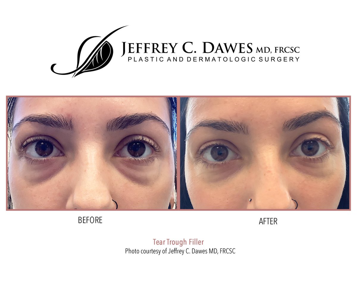 JeffreyCDawesMD's tweet image. Tear Trough Filler (under eyes) can truly refresh your appearance. See the difference that dermal fillers can make! #beforeandafter #fillers #undereyefiller #dermalfillers #injectables #nurseinjector