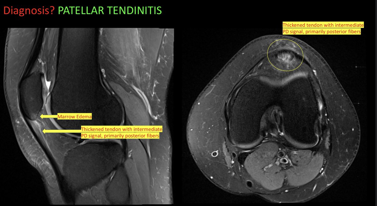 amfischer89's tweet photo. Case 25-PATELLAR TENDINITIS. See companion case and attached teaching points. Enjoy! @ufjaxrads #FOAMed #FOAMrad #radiology #MSKRad #radres #futureradres #MedEd #medtwitter #orthotwitter @SSRbone @ssr_rwg @KurraChandana https://t.co/Uhgusm3INc