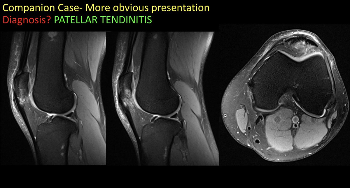 amfischer89's tweet photo. Case 25-PATELLAR TENDINITIS. See companion case and attached teaching points. Enjoy! @ufjaxrads #FOAMed #FOAMrad #radiology #MSKRad #radres #futureradres #MedEd #medtwitter #orthotwitter @SSRbone @ssr_rwg @KurraChandana https://t.co/Uhgusm3INc