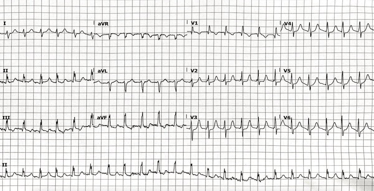 rob_buttner's tweet photo. 25 👩 with SVT.

There is one ECG feature that suggests a congenital structural heart defect, can you spot it?

https://t.co/svZPT3Mbd5

@AslangerE @dmccreary85 https://t.co/5RUsEIxOlZ