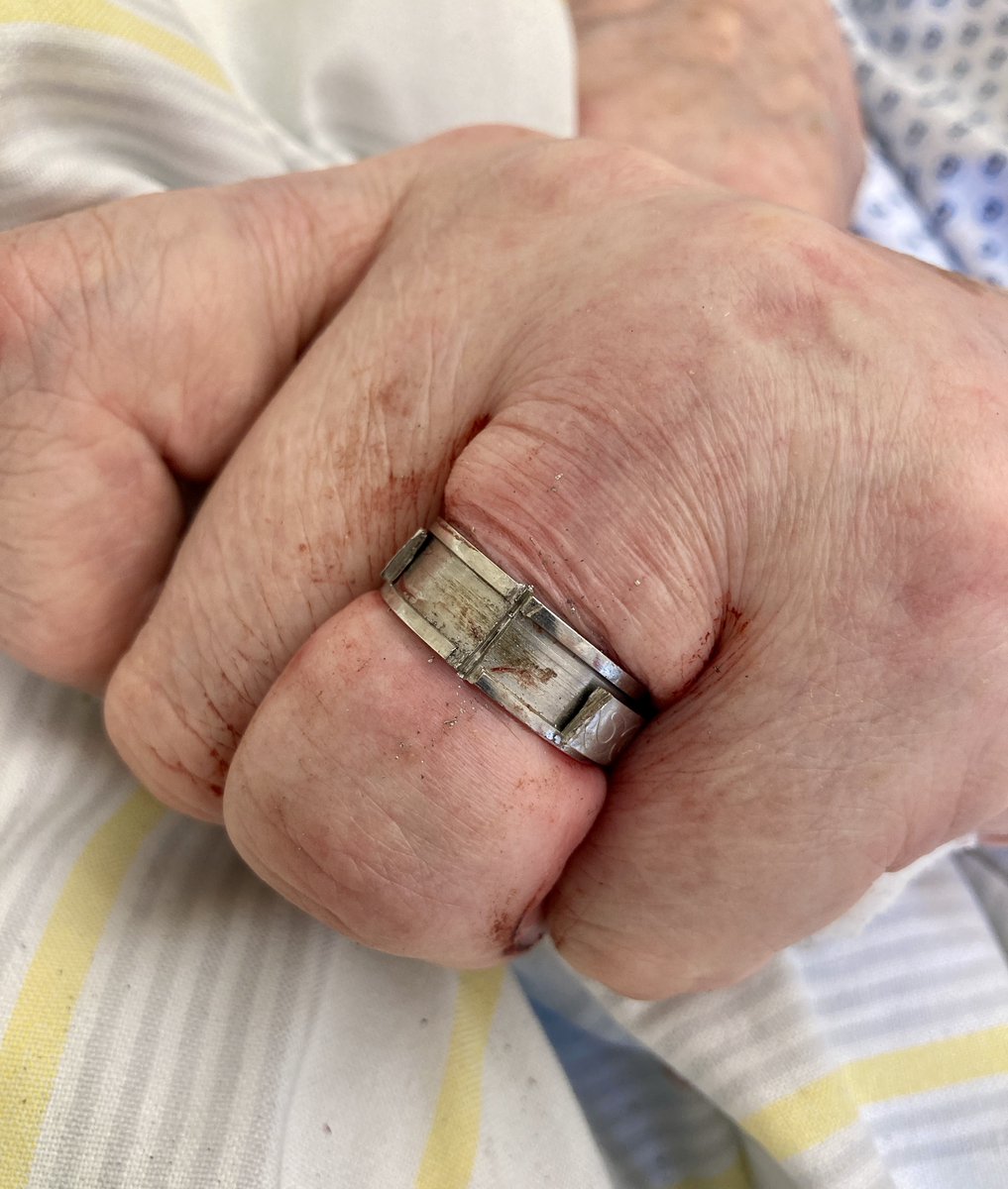 ISurgmed's tweet photo. Neu konzipierte Fingerringsäge Model "ZOBIREI" unter Notfalleinsatz (Doppeledelstahlring) am Klinikum in Plauen, Deutschland. 
Handelsvertrieb für die Schweiz https://t.co/XOhRoZPEgT

 #innovation #notfall #fingerringsaege #notfallinstrument #surgical #healthcare https://t.co/uGeucYixFM