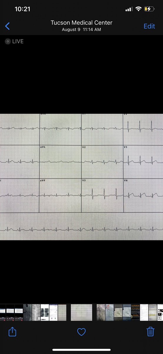 DrTomWaggoner's tweet photo. Challenging Case:

72yo WM w/delayed lat STEMI shock. Impella CP DES to Lcx/LAD. TEE: ruptured post pap muscle  4+MR. Impella-assisted TEER w/ XTW x1 on medial A2/P2. Pt d/‘c POD 6. #Clip-Pella case. @TAVRBot @GilbertTangMD @RajTayalMD @JasonFoerst @J_M_McCabe @DrAmirKaki https://t.co/ZuLdMDfLCR