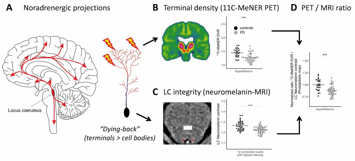 Brain1878's tweet photo. Dying-back of ascending noradrenergic projections in Parkinson’s disease.

New scientific commentary by Rick C Helmich &amp; Stéphane Lehéricy

https://t.co/X9jcsXuUAv; https://t.co/zorKE73HID https://t.co/6BG9AHGlwn