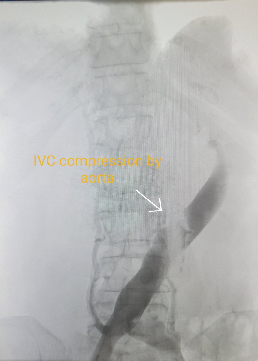 TempleRADs's tweet photo. Patient with massive abdominal sarcoma. Venogram performed for preoperative planning by Dr. Nameet Patel. Check out the location of the right kidney and course of IVC! Amazingly, patient had relatively few symptoms. @TempleRadRes @SIR_ECS @SIRRFS #IRAD https://t.co/7hpRMOsg8l