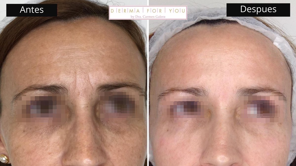 Dermaforyou's tweet photo. Nuestra paciente viene de lejos! En su 1 visita le planifique su #SistemaSkinlayer:
1. Tto médico: #Botox.
2. Tro cabina : #Dermalinfusion
3. Tto cosmético : Brigtnex 0.25 de @zoskinhealth
4. Estilo de vida saludables + fotoprotección.
Esta es su piel al cabo de 2 meses. https://t.co/twuPvBpGZE