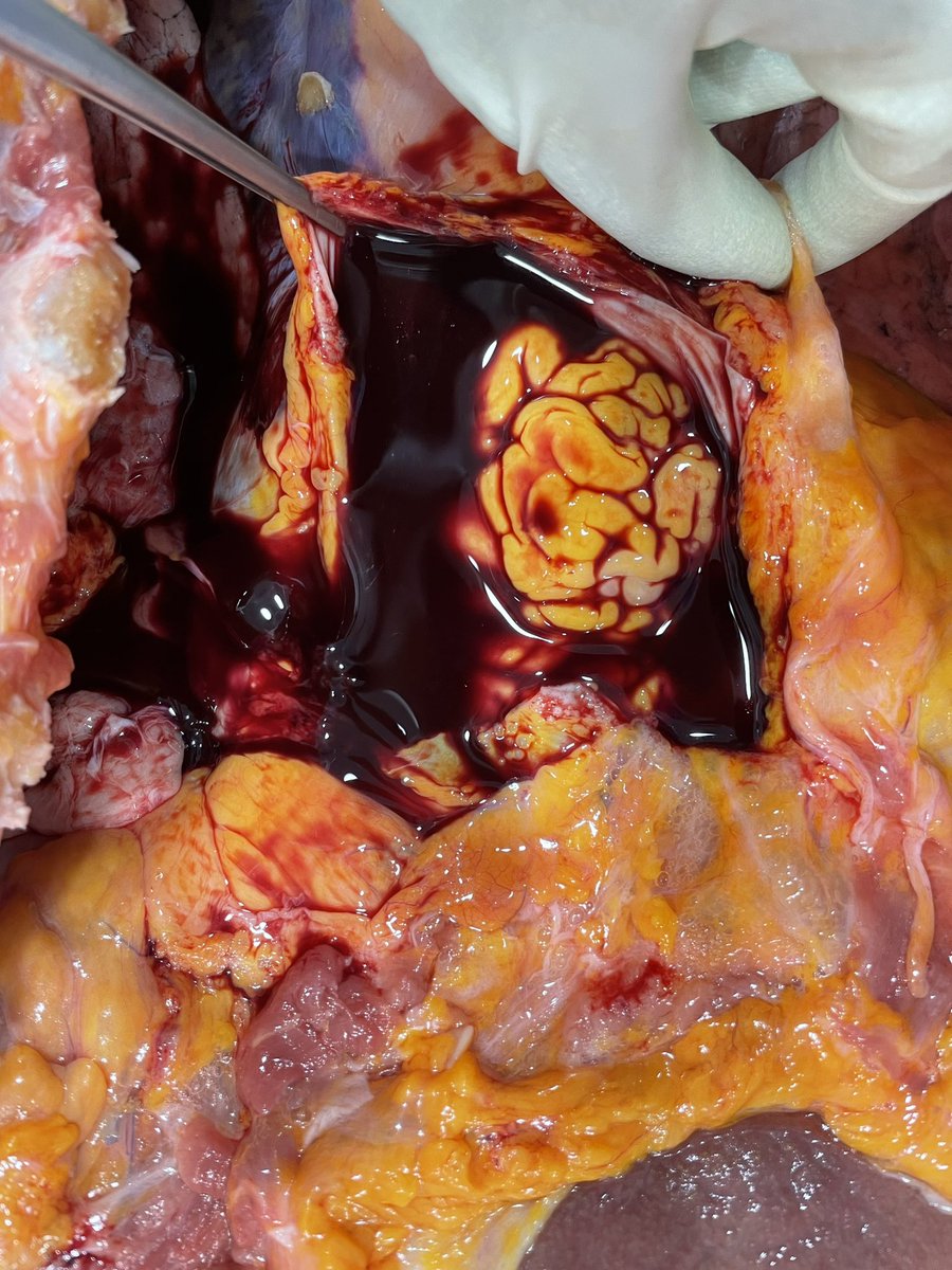 vitopuntocom's tweet photo. The most fearful complication of myocardial infarction ... #PathTwitter #autopsypath #cardiopath #pathology #pathresidents #forensics @raghupillappa @thedermypathres @Alysha_Martini @martiponi @JanaVPath @Josesordo @atman_ci @JulianBurton15 @nucleololailo https://t.co/ev76LlaJ9z