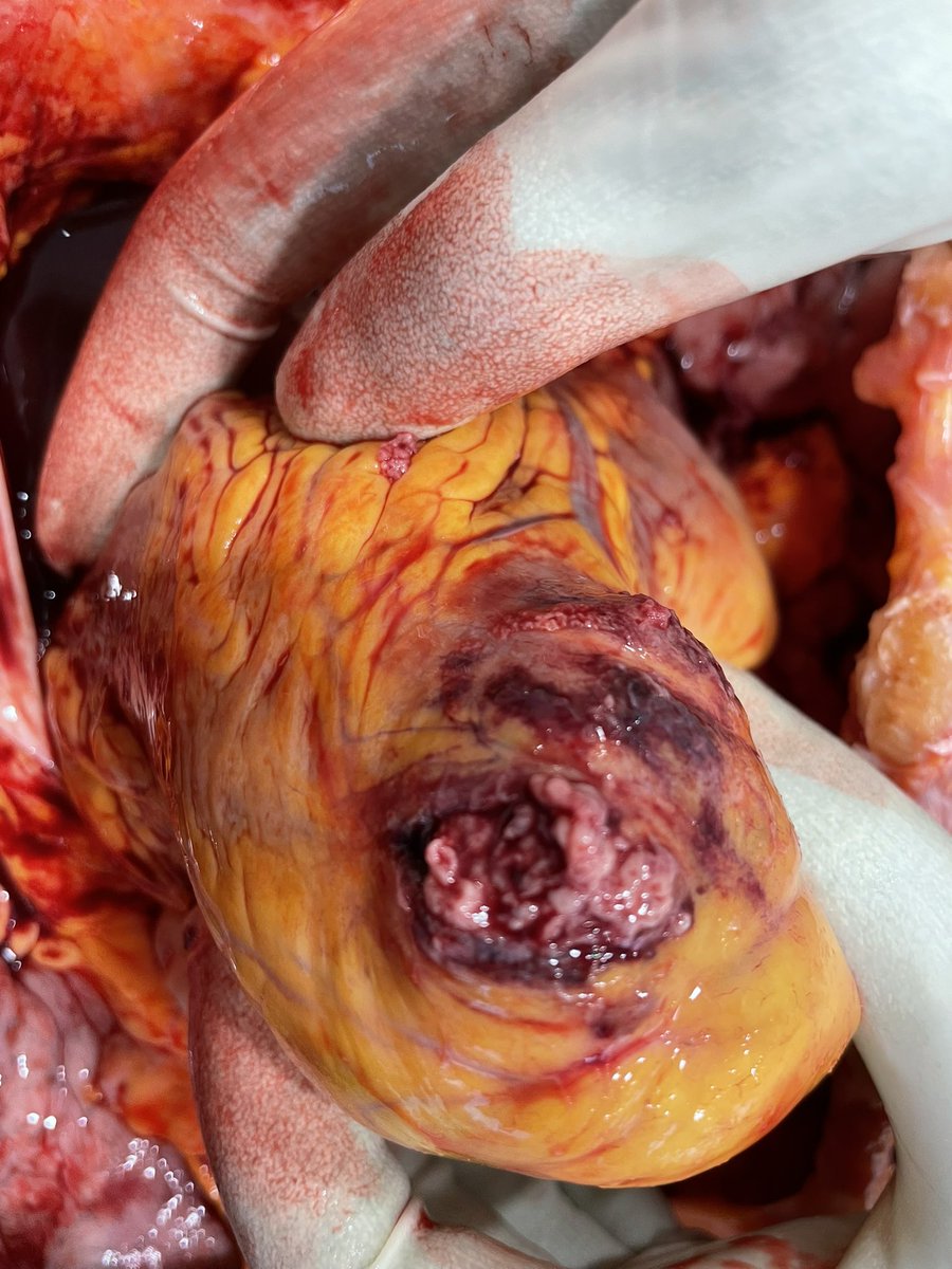 vitopuntocom's tweet photo. The most fearful complication of myocardial infarction ... #PathTwitter #autopsypath #cardiopath #pathology #pathresidents #forensics @raghupillappa @thedermypathres @Alysha_Martini @martiponi @JanaVPath @Josesordo @atman_ci @JulianBurton15 @nucleololailo https://t.co/ev76LlaJ9z