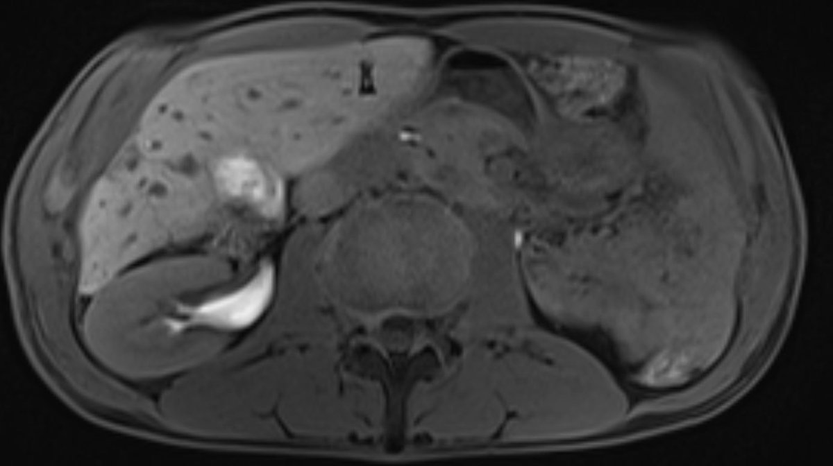 The British Society of Interventional Radiology tweet media