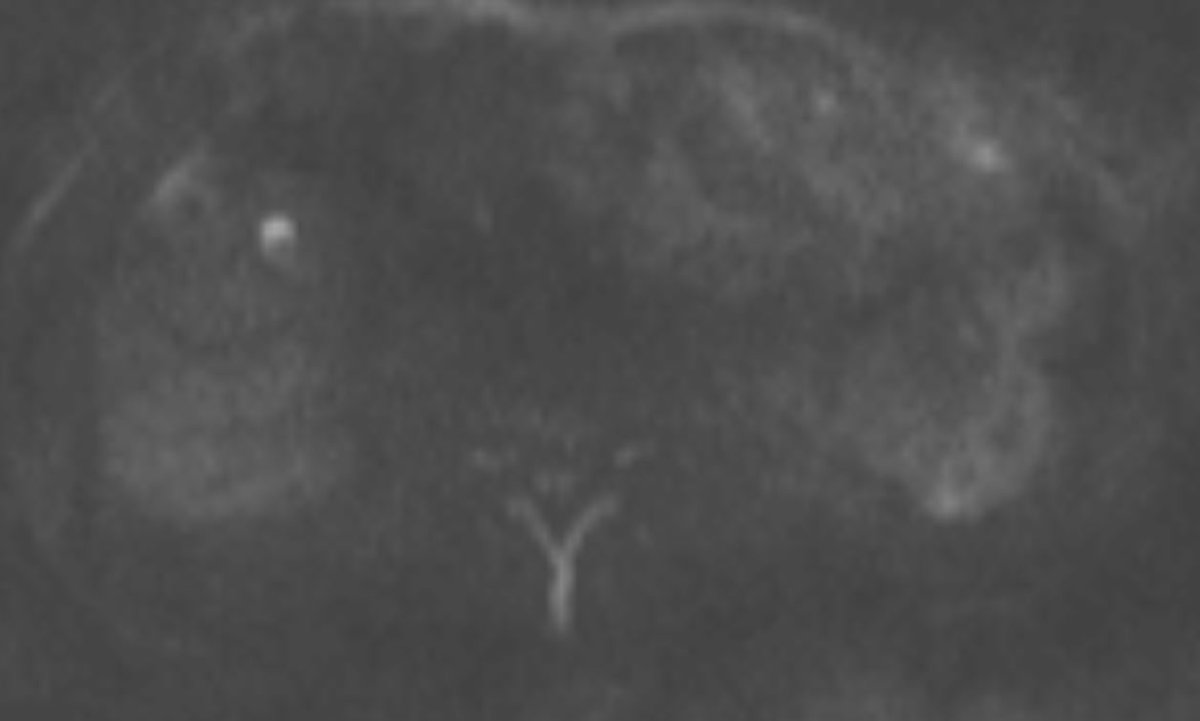 The British Society of Interventional Radiology tweet media