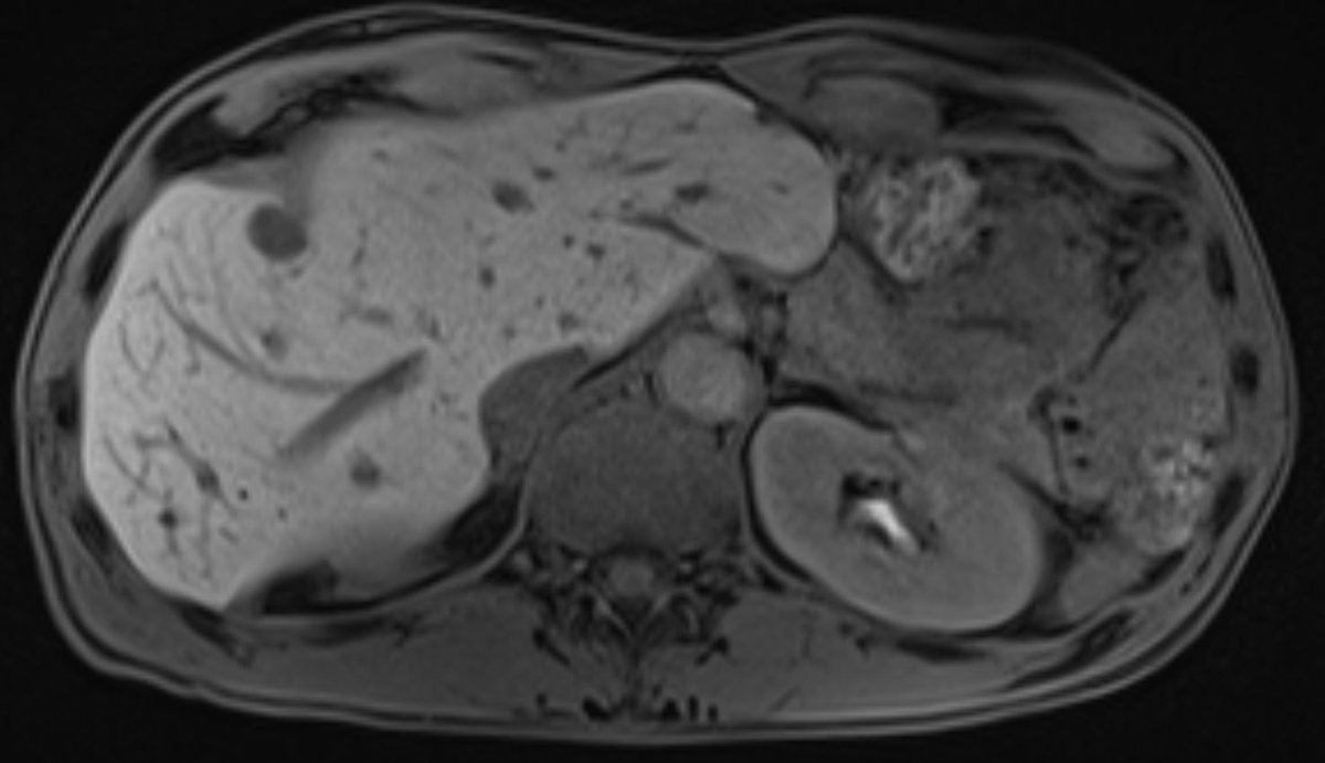 The British Society of Interventional Radiology tweet media