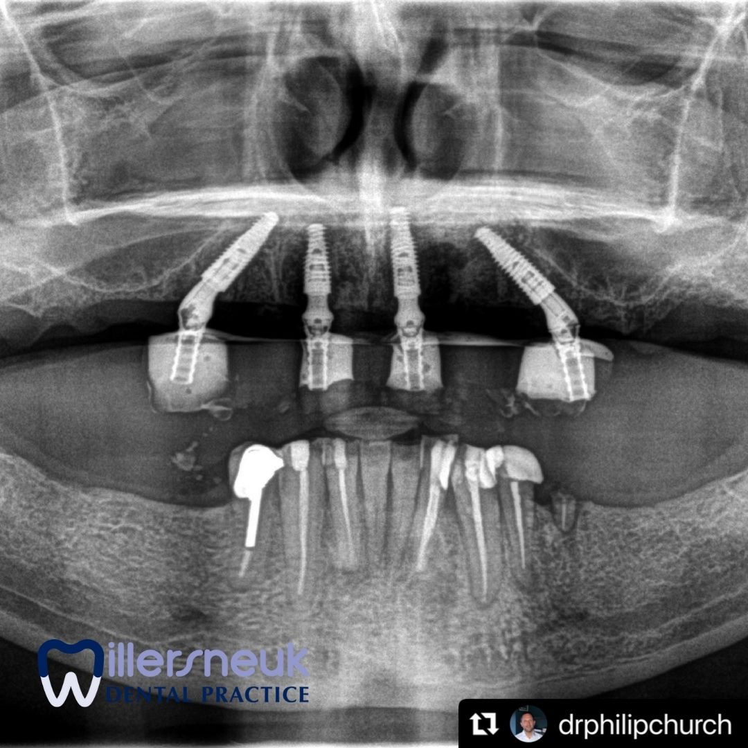 dentalglasgow's tweet image. This patient had failing bridges. Philip managed to give him the #samedayteeth option and will follow up with the final #fixedbridge.

👉 dentalglasgow.co.uk/contact/
📞 Call 0141 777 7511

#dentalimplants #dentalsurgery #dentalclinic #glasgowdentist #fullarch