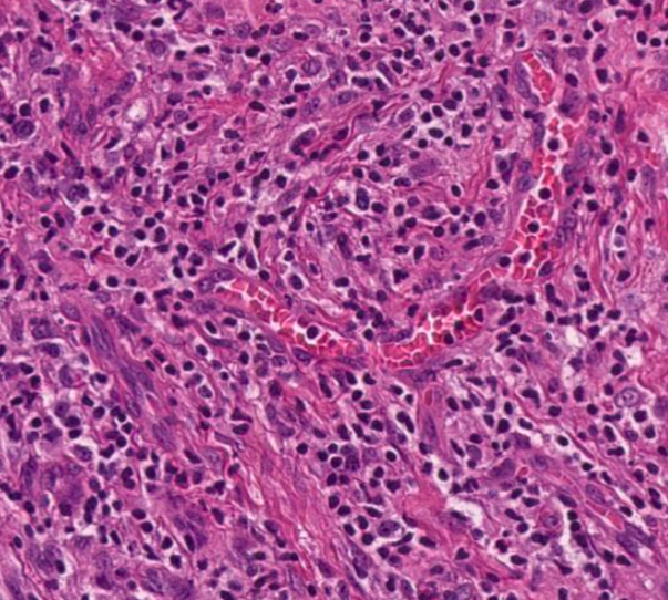 SibaElHussein's tweet photo. #LessonsfromtheFridayUnknowns AITL is morphologically the CHL of T-cell lymphomas, classic case shown by @ljmedeirosMD
 during #LJMFridayUnknowns + notes and discussed articles➡️https://t.co/CLa64Bi9y1
#hemepath #pathtwitter #lymsm
@KirillLyapichev @RMirandaMD @Xiaoqiong_Wang https://t.co/27YBmlLLTo