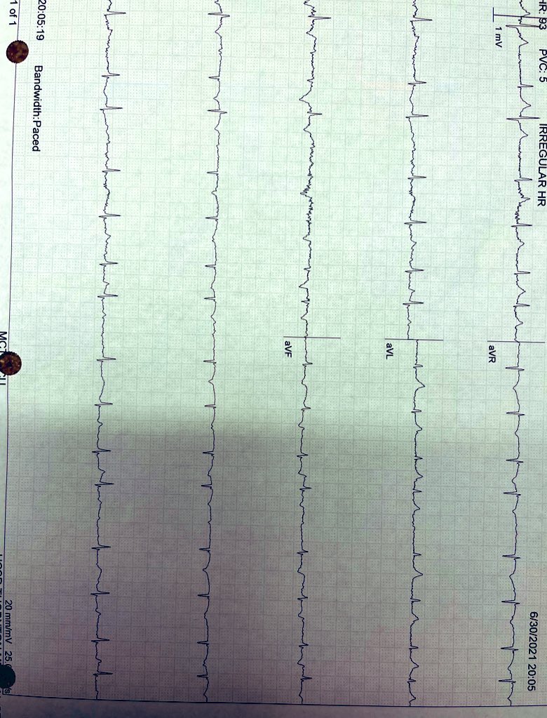 Christiano963's tweet photo. @HRS_CaseReports Presenting a male patient with Mitral Regurgitation, non-collapse. Please,  feel free to input your educational rhythm interpretation. https://t.co/QX7hZZn9G1